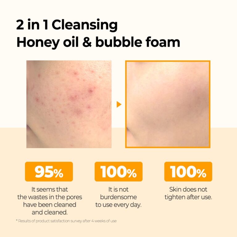 Før- og efterbilleder viser mindre rødme og glattere hud efter brug af Some Bi Mi - Propolis B5 Glow Barrier Calming Oil To Foam 120 ml, med brugertilfredshedsprocenter vist under billederne.